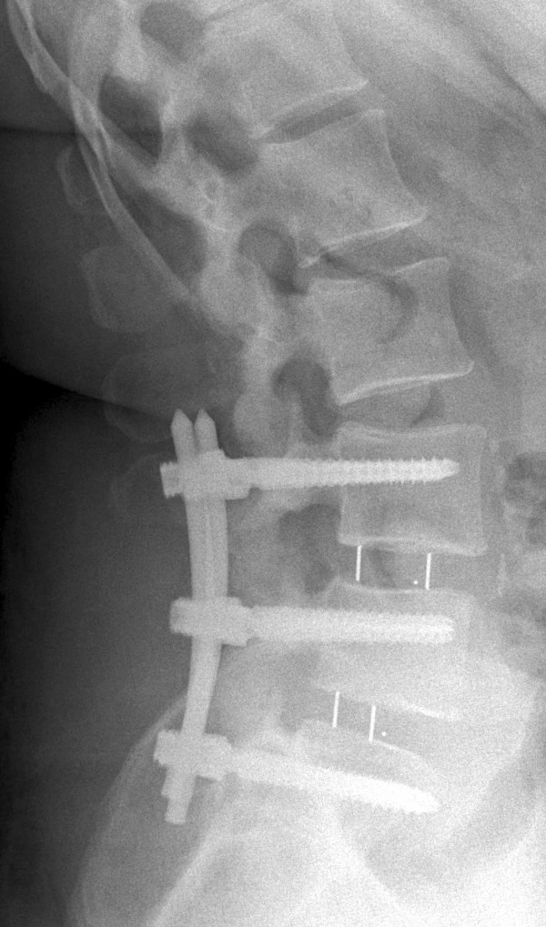 An X-ray of a human spine with an interbody fusion device inserted.